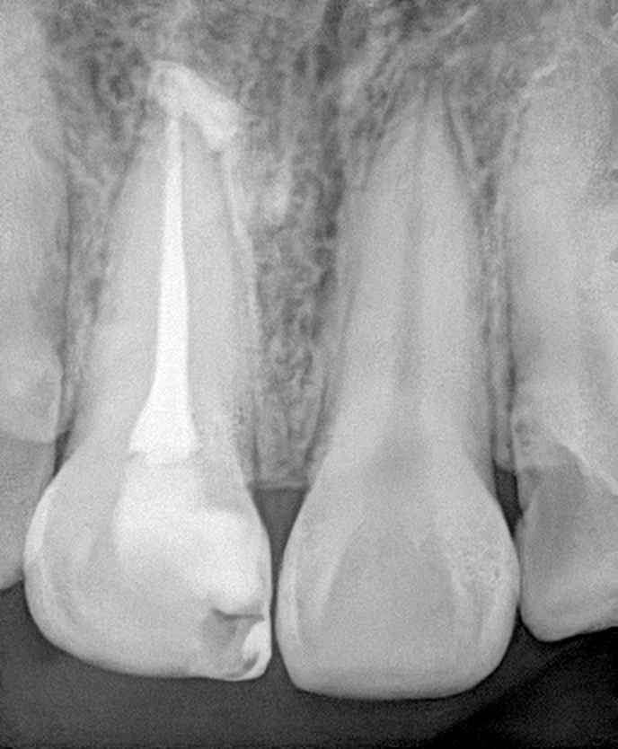 Crystal-clear dental radiograph created with RVG19X sensor